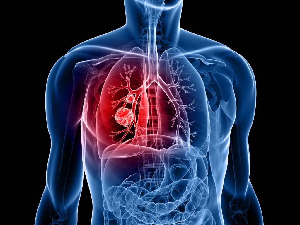 Lungekreft illustrasjonsbilde av gjennomsiktig "kropp" der lungen er synelig.